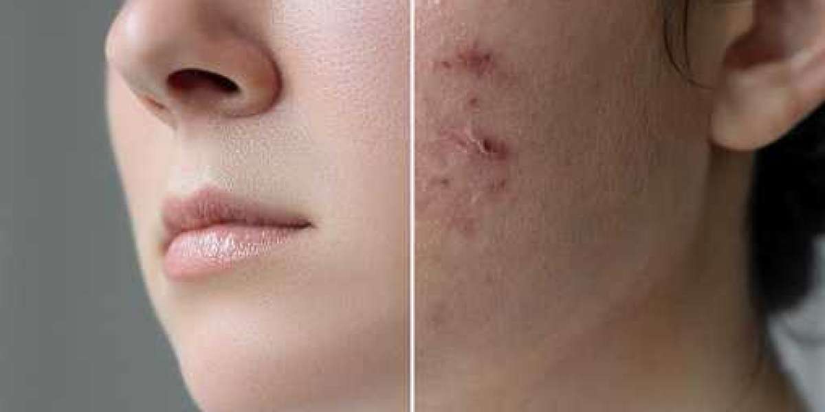 Simple Ways To Treat And Manage Your Acne